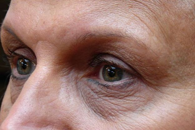 Les veines sous les yeux : causes et traitements - Aram Clinique ...